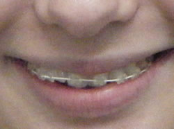 Braces Gresham