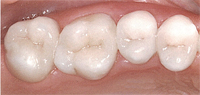 Porcelain Crowns Gresham