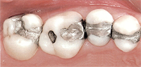 CEREC Crowns Gresham