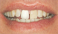 Gresham Porcelain Veneers